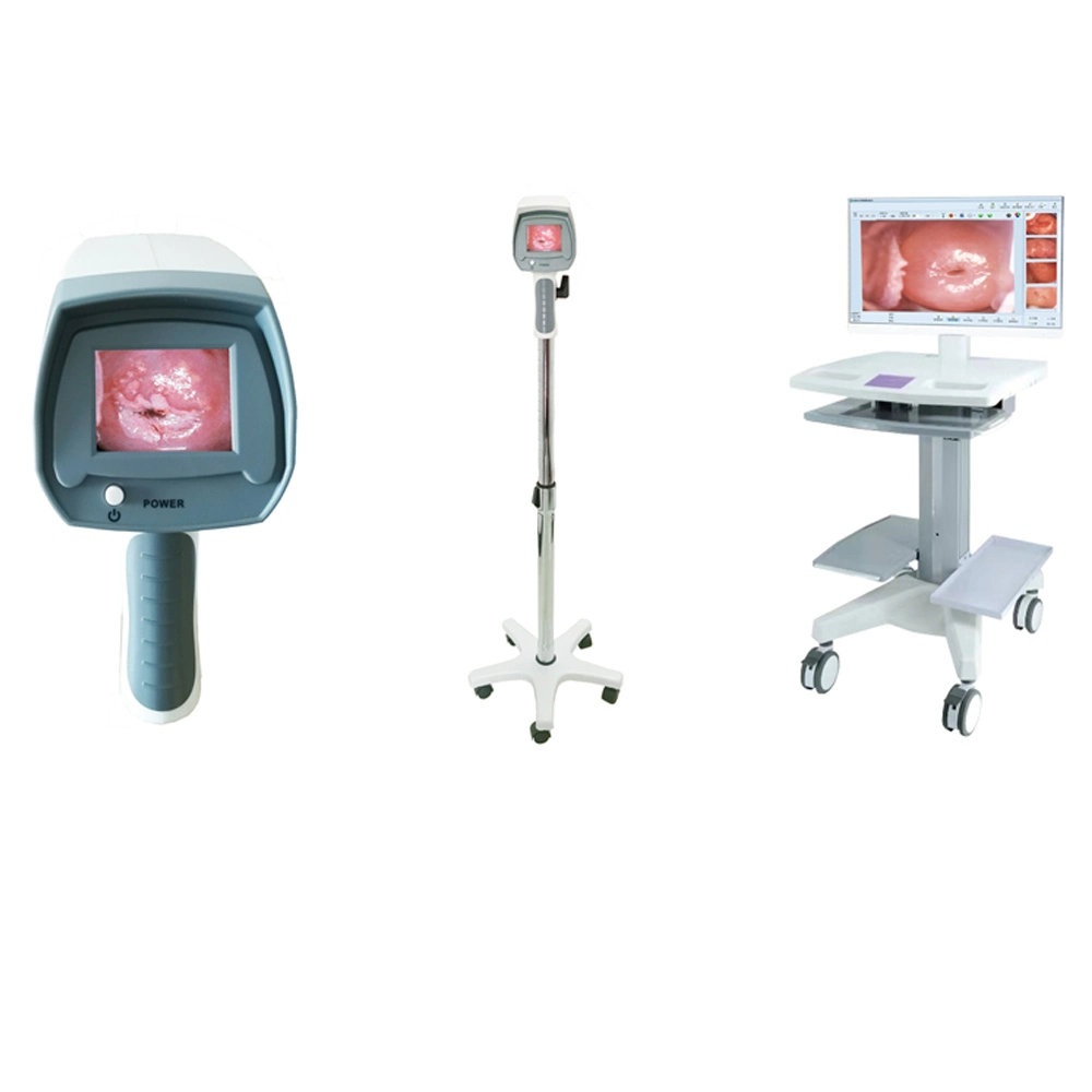 Electronic Colposcope Video Colposcopy for Gynecology