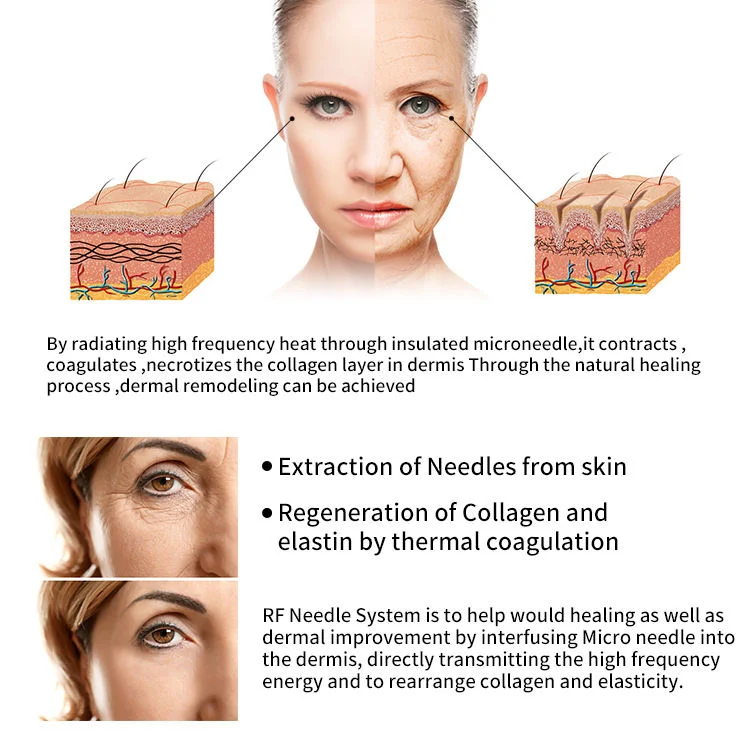 Fractional Morpheus 8 Mini Vmax Machine Advanced Technology for Skin Resurfacing Colleagen Renewal