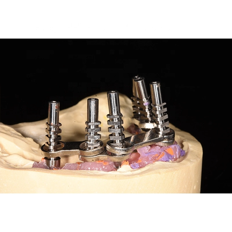 All on 4 Dental Prosthesis Metal Implant Supported Overdenture Bar