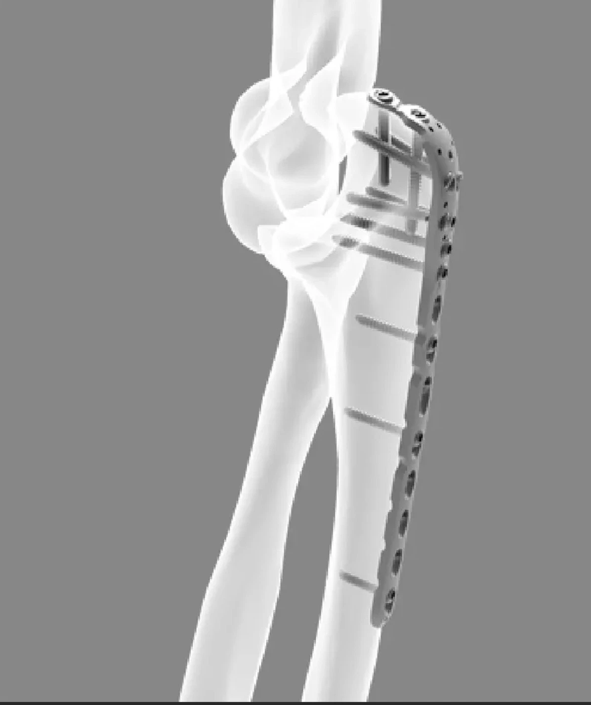 Titanium Trauma Orthopedic Implant Locking Plates for Distal Humerus