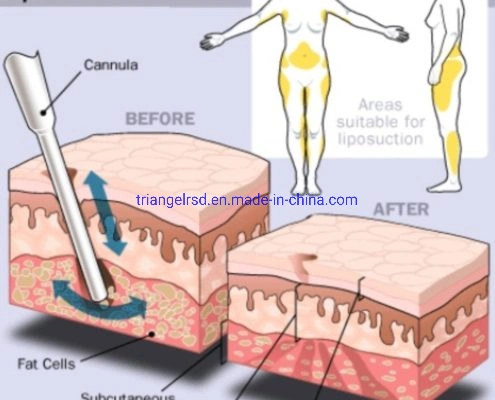 Liposucción láser Liposucción facial Lipo 1470 Cirugía Lipo Eliminación de grasa instrumento