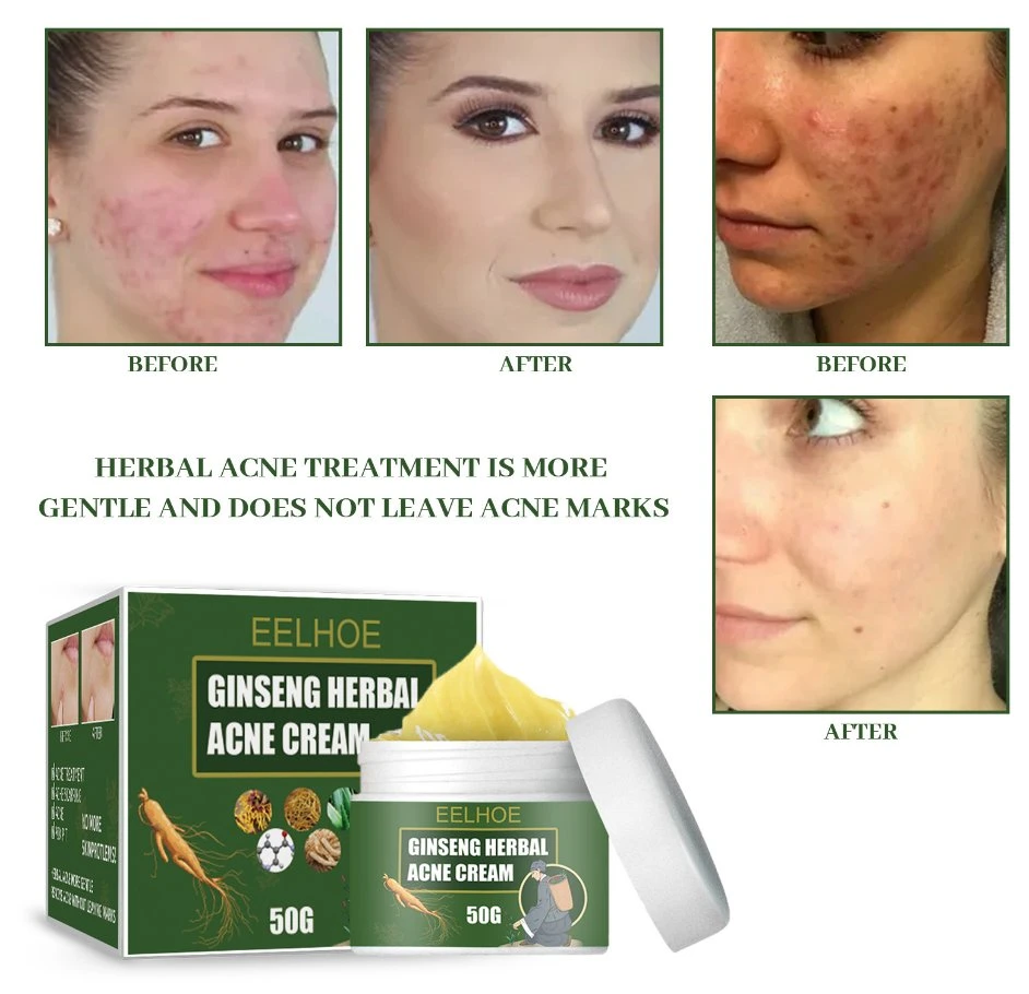 Costom Effective Acne Removal Cream Herbal Acne Spots Oil Control Acne Cream Skin Care Whitening Moisturizing Face Gel Skin Care Acne Removal Cream