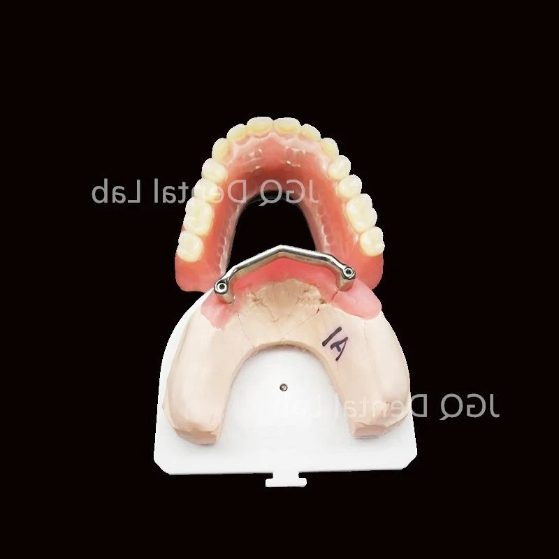 All on 4 Dental Prosthesis Titanium Implant Supported Overdenture Bar