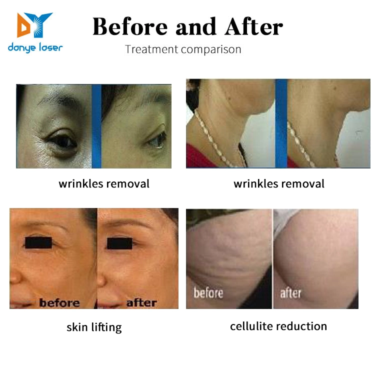 Wrinkle Removal RF Equipment Anti-Wrinkle High Frequency 6.78MHz Skin Tightening Machine