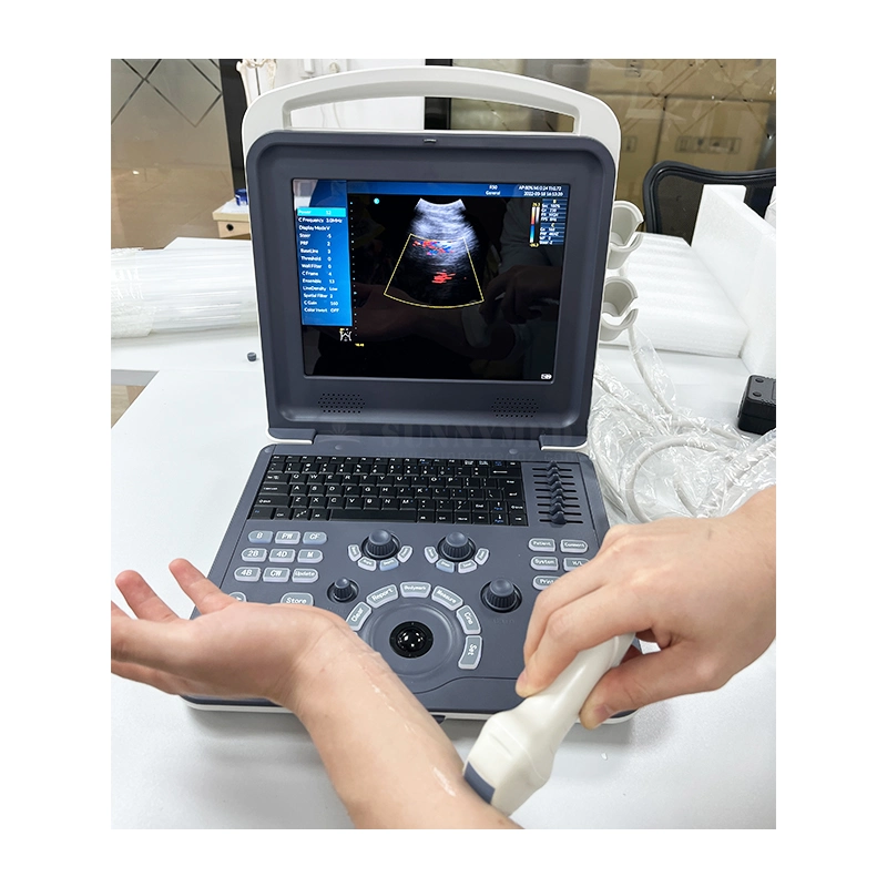 Sy-A042-1 Medical Potable Color Doppler Ultrasonic Diagnostic System Ultrasound Machine