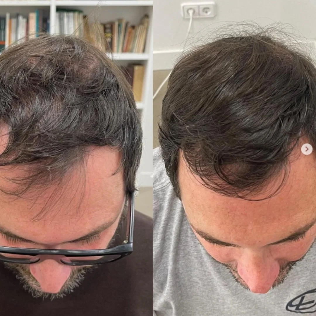 2023 Venta caliente Exosome Asce+ Hrlv para cuero cabelludo, rejuvenecimiento y la pérdida del cabello pelo de la ASCE Exosome rejuvenecimiento de la restauración de cabello El crecimiento del cabello