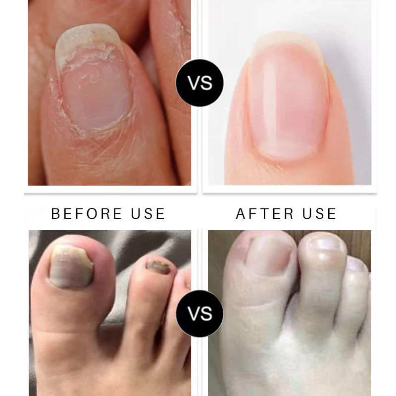 Discolored Damaged Nails Repair Treatment Serum