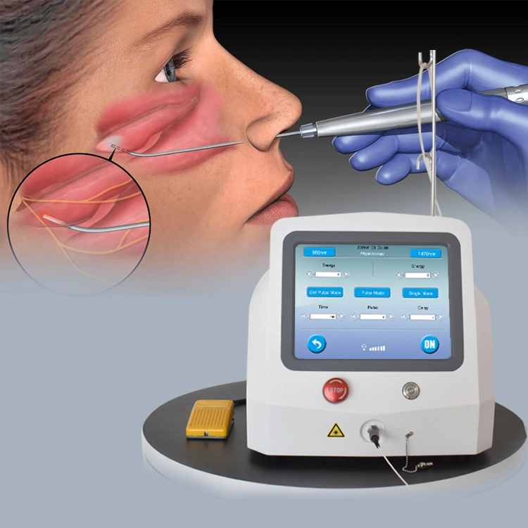 Diod Laser 980 Nm for Ent Surgery New Ent Laser Surgery Ent Mini-Invasive Surgery Device 1470nm Laser