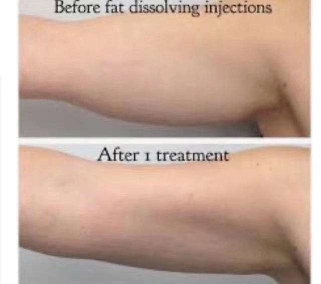 Injections Aqualyx Lipo Lab Ppc Kabelline Lipolysis Solution