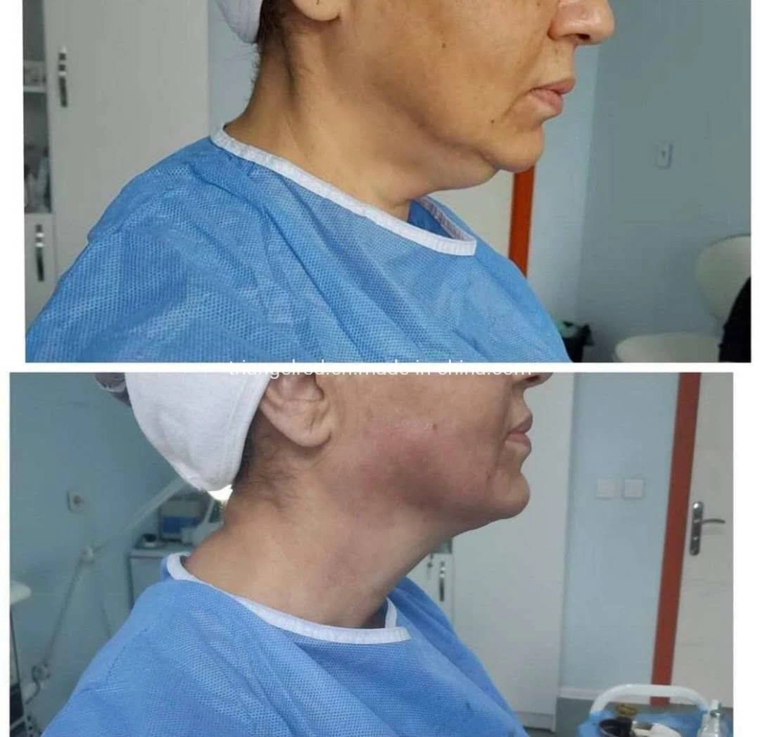 980nm Удаление жира Slimming машина Endolaser Lipolisis Vaser Liposuction ЭндоЛазер Лазерная машина Пластиковые хирургические средства