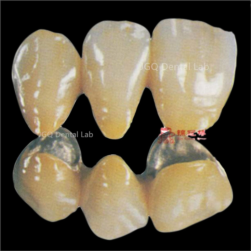 Dentures Teeth Metal Porcelain Ceramic Implant Pfm Crowns and Bridge From China Dental Lab