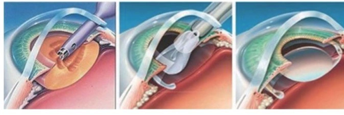 Biofermented Sodium Hyaluronate Surgical Supplies Materials Endothelial Cell Protection Viscolastic Solution