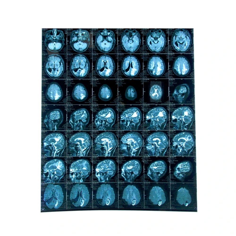 Wholesale/Supplier for Universal Blue Based Pet Inkjet Medical X-ray Film 175um for Radiology Department