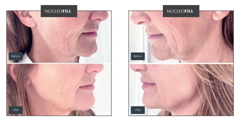 Nucleofill or Profhilo Treatment Nucleofill Strong for Under Eyes Anti Aging Cheek Efekty Zabieg Opinie Nucleofill Soft Eyes Mesotherapy