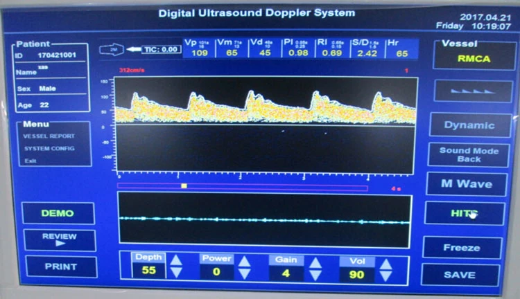 Mi-A041 Carro de Hospital de Ultrasonido en Medicina de la máquina Tcd Equipo Doppler transcraneal