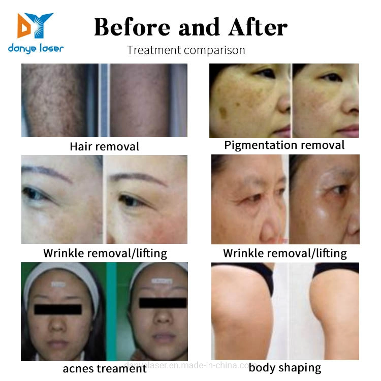 العناية بالجلد العناية بالضوء الأجهزة إزالة الشعر إزالة الشعر بتقنية IPL Pigment علاج حب الشباب آلة رخيصة IPL