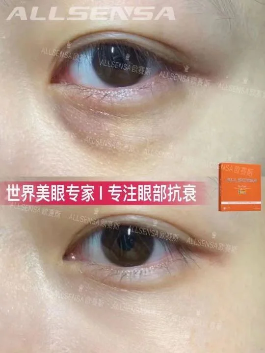 Allsensa Hyaeyes Antioxidantien periocular Gene Peptide for Dark Eye Circle Eyebag Augenfalten Entfernung Hyaluronsäure Injektion Haut Booster