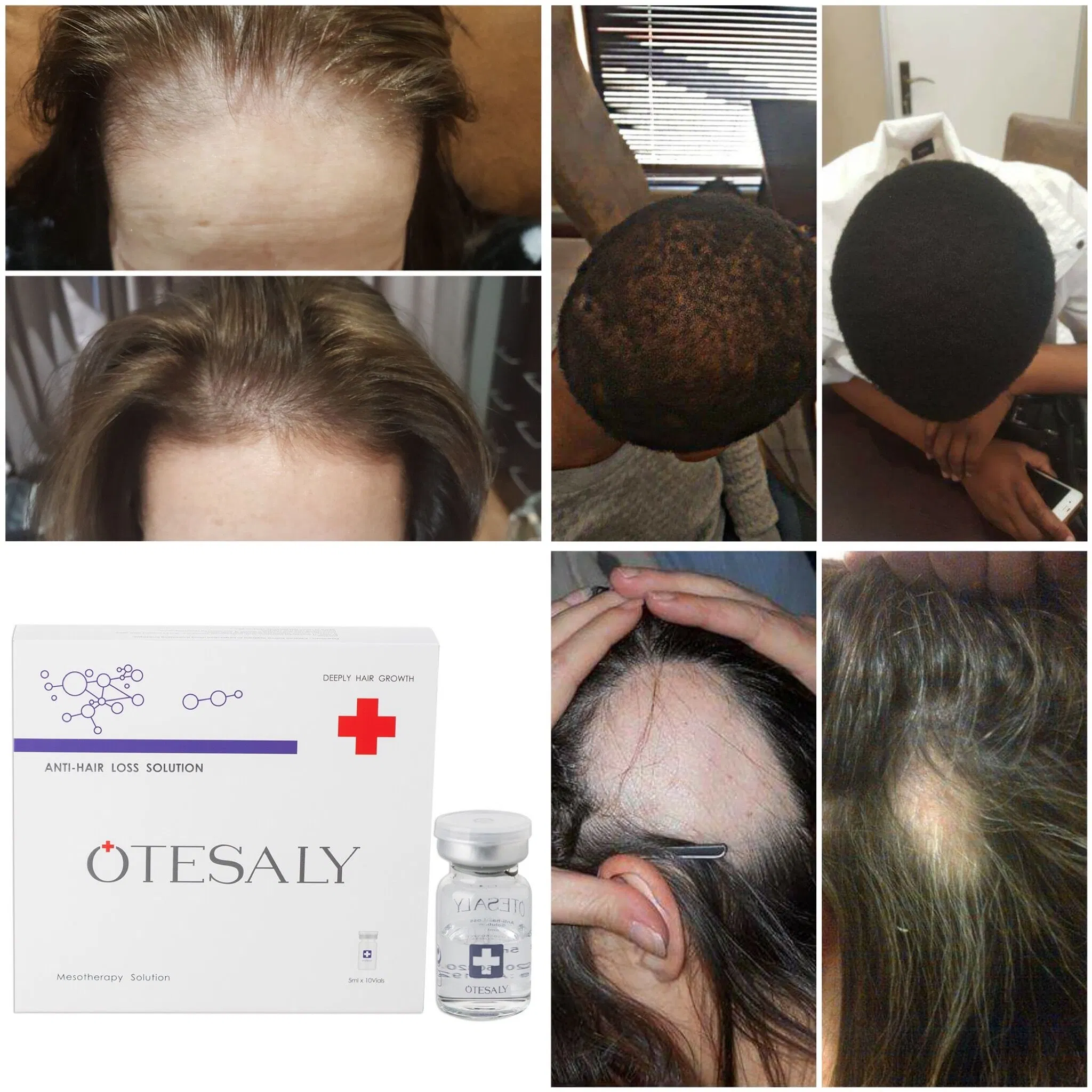 Anti Hair Cocktail Hair Loss Treatment Mesotherapy Otesaly Price