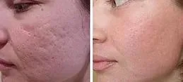 2023 Hot Selling Korea Original Jovelook Hybrid Collagen Stubeator Skin تعزيز حمض اللاكتيك Aestheالتعبئة Etrebelle Sculpta 5D Pdlla Plla حمض هاهاهاولورونيك