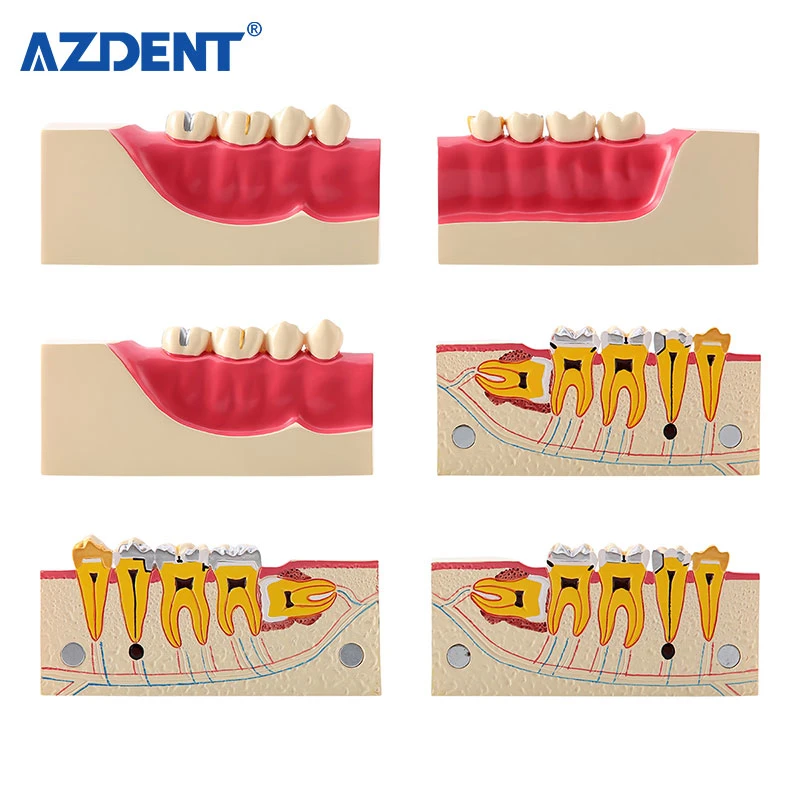 Zahnmedizinisches Lernmodell Rechtes Unteres Posteriores Zahnmedizinisches Gewebezersetzungsmodell