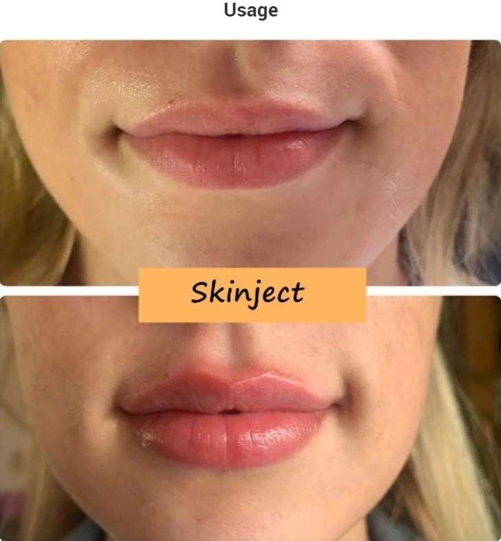 Inquiry About 2ml Hyaluronic Acid Gel Injectable Ha Dermal Filler Lips Enhancement