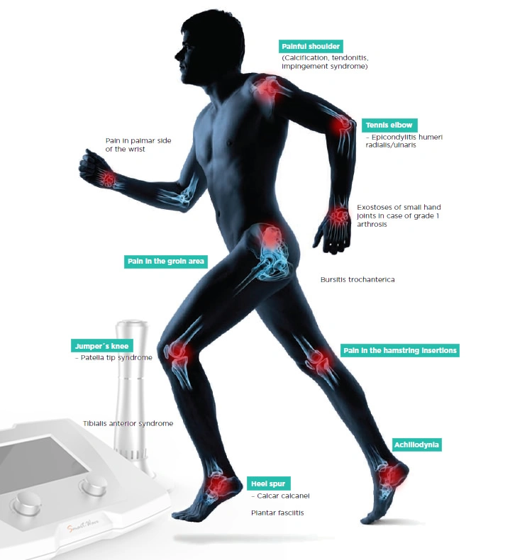 BS-TS2X Terapia Shockwave Radial para Tratamento de Tendinose Ombro