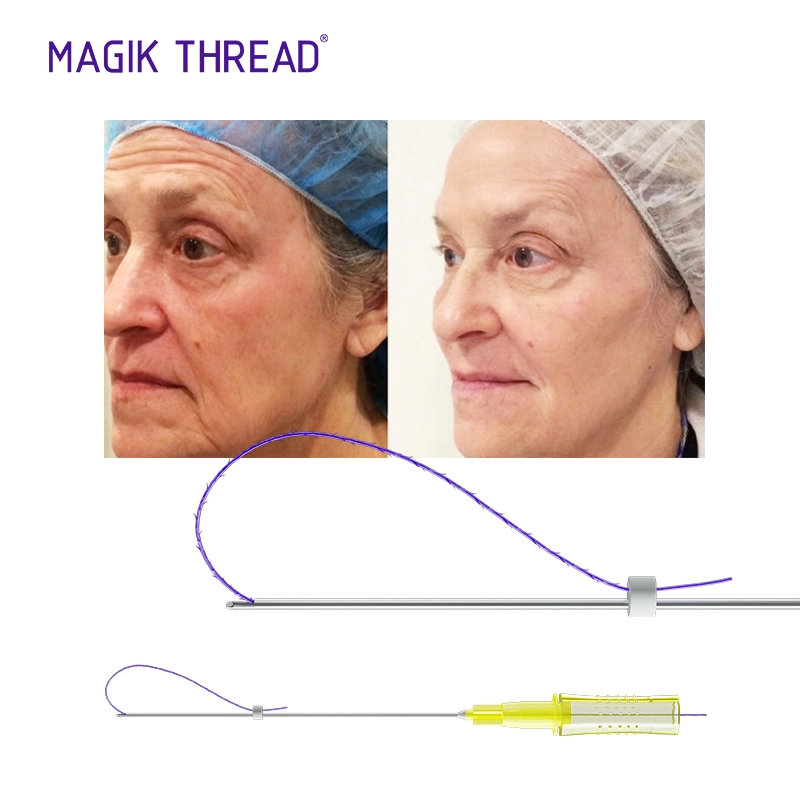 Magik Thread Medical Wrinkle Removal Fios Pdo Cog 4D Facial Lifting Pdo Thread