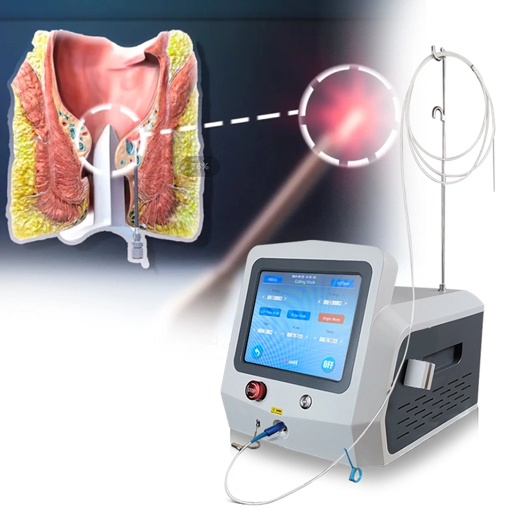 Doctor Recommended Anal Fistula Piles Hemorrhoids Sinus Pilonidal Surgery Laser 980nm 1470nm Triangelmed Proctology Surgery Medical Diode Laser Machine