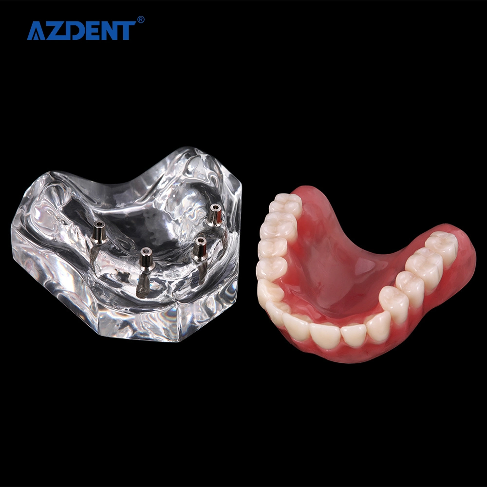 High quality/High cost performance CE Certified Standard Plastic Dental Implant Teeth Model