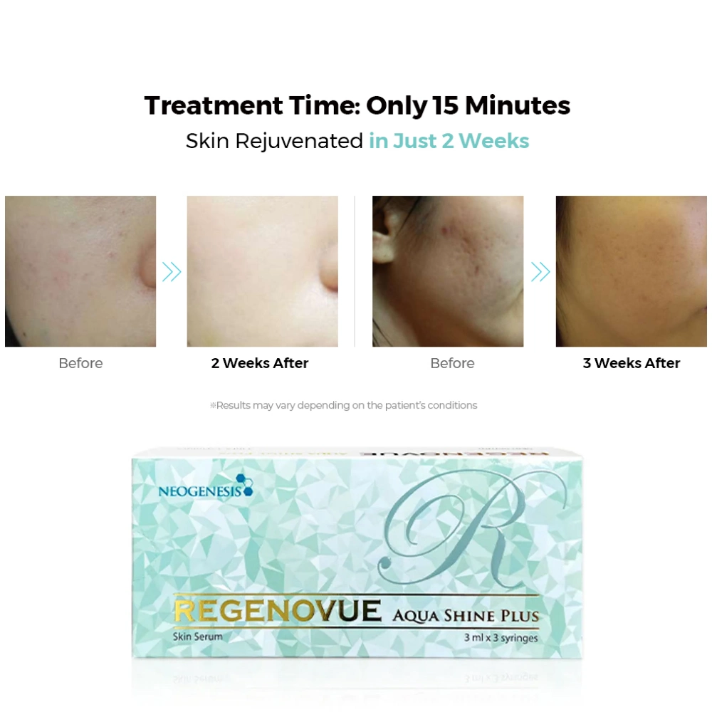 Regenovue Aqua Shine Plus Skin Boosters Dermal Fillers Anti Wrinkles Hyaluronic Acid Mesotherapy Skin Booster Skin Rejuvenation Aquashine Booster