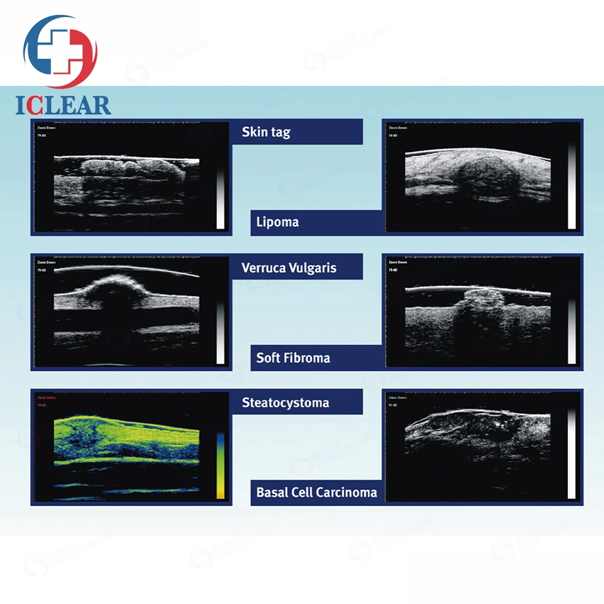 50UM B &amp; B+D'une peau de diagnostic à ultrasons de dermatologie par voie non invasive Scanner