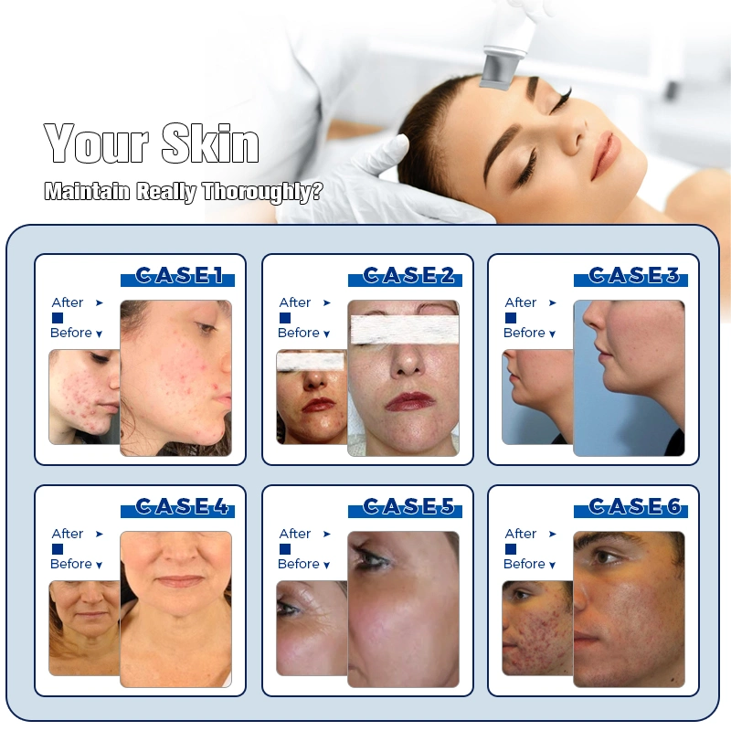 Hydrofacial Deep Hydro Dermabrasion Facial Dermabrasion Machine