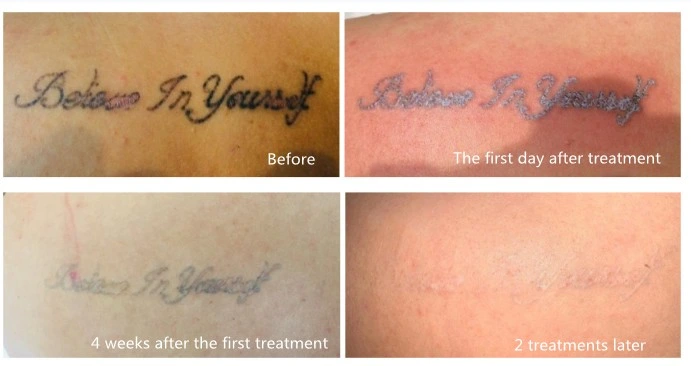 CE-Zertifizierung ND YAG Laser Pikosekunde Laser Tattoo Entfernung Maschine Pigmententfernung Hautaufhellung