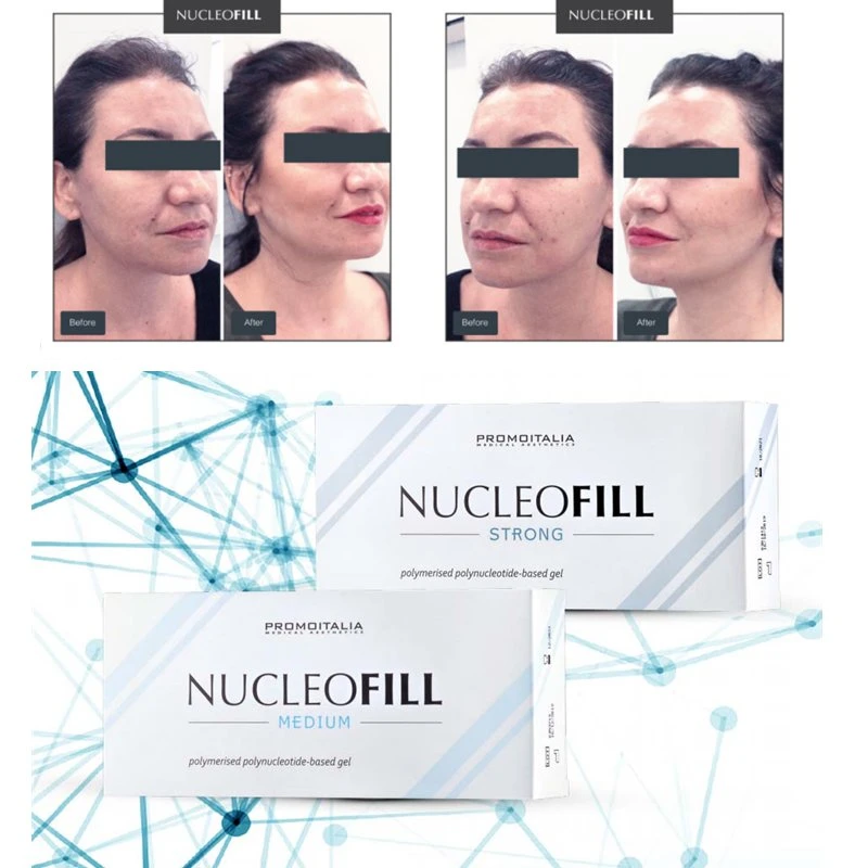 Kaufen Nucleofill oder Profhilo Strong Medium 1,5ml Weiche Augen Haar Mesotherapie Lifting auf zellulärer Ebene Behandlung Haut Booster Straffende Anti Alterungsfalten Produkte