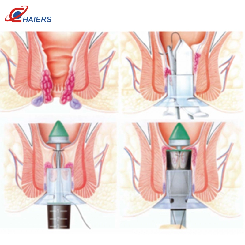 Agrafeuses chirurgicales jetable circulaire matériel chirurgical Hémorroïdes jetables et des accessoires de l'agrafeuse de coupe circulaire à l'hôpital