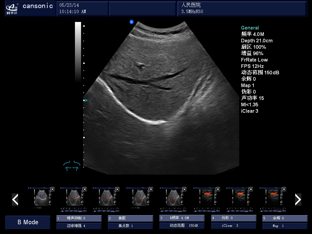 Échographie Doppler couleur 4D sur chariot (K10)