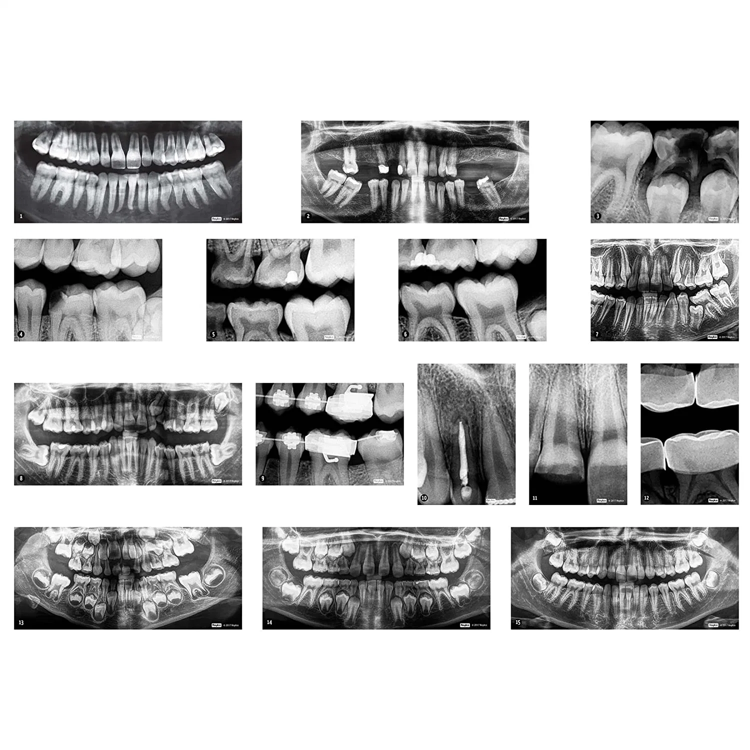 Lyd Digital Dental X-Rays Films for Hospital Cr Dr Medical X-ray Film Dry Blue Medical Film 8*10