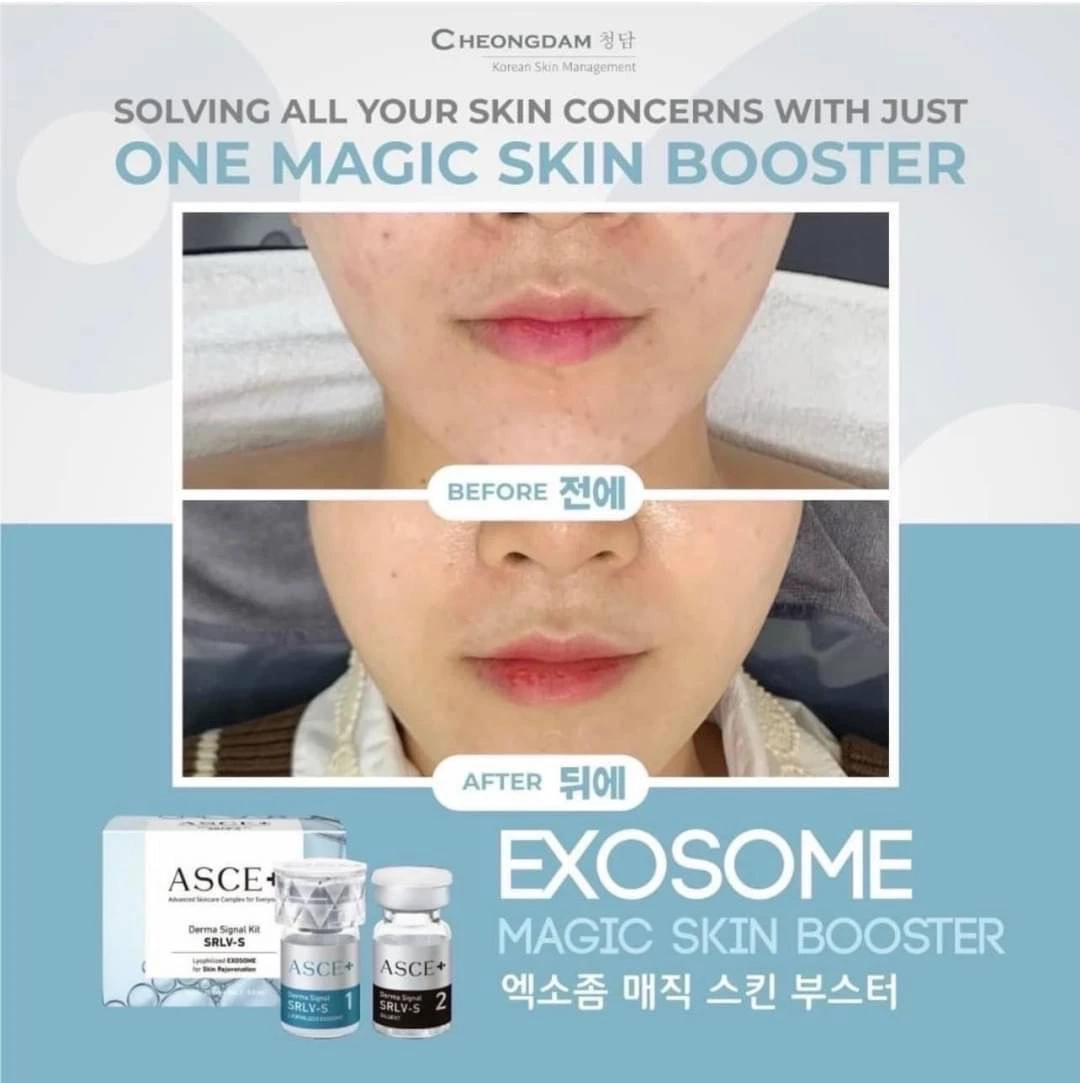 Asce + Srlv Exosome Skinbooster Mts PARA Cara De Corea Lifting Du Visage Anti-Vieillissement Skin Whitening Anti Aging Hair Growth Anti-Aging