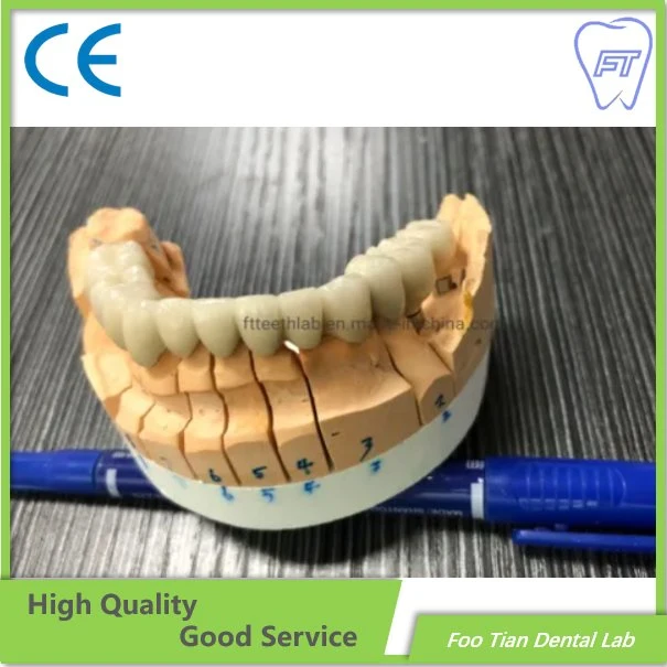 L'Orthodontie Traitement dentaire couronne en céramique de métal faites dans foo Tian Dental Lab à Shenzhen en Chine