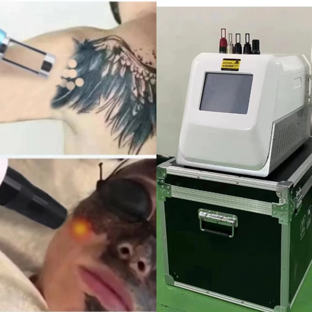 ND YAG Laser Beauty Salon Equipment Qswitch Laser Tattoo Removal