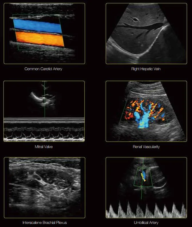 Edan Veterinary Color Doppler with Convex/Linear/Micro-Convex Probe U60 Price