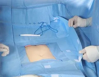 Emballage stérile jetable pour chirurgie laparotomie