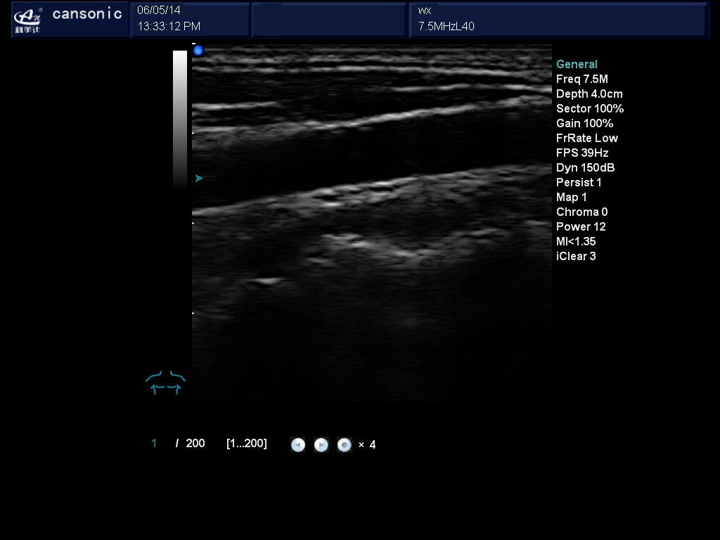 Portable Color Doppler Ultrasound Scanner for Cardiology