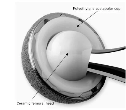 Customized 3D Printed Titanium Alloy Acetabular Titanium Cup for Medical