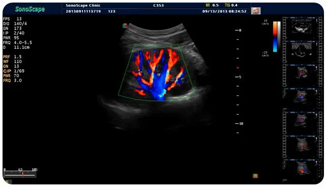 Sonoscape 5D Echo Machine Ultrasound Scanner with Convex Linear Cardiac Transducers for Pregnancy S8 S9 Price