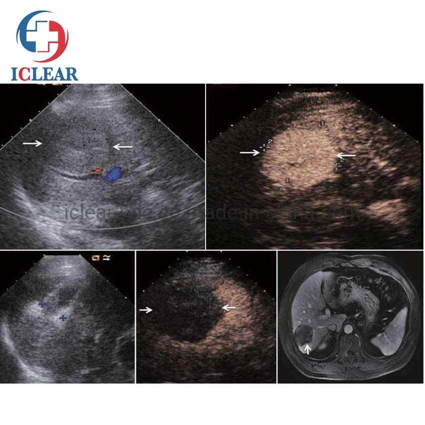 Appareil de traitement de chirurgie tumorale par ablation au micro-ondes de haute qualité