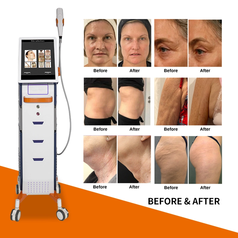 Nueva máquina anti-arrugas HIFU Corea para levantar la cara sin dolor