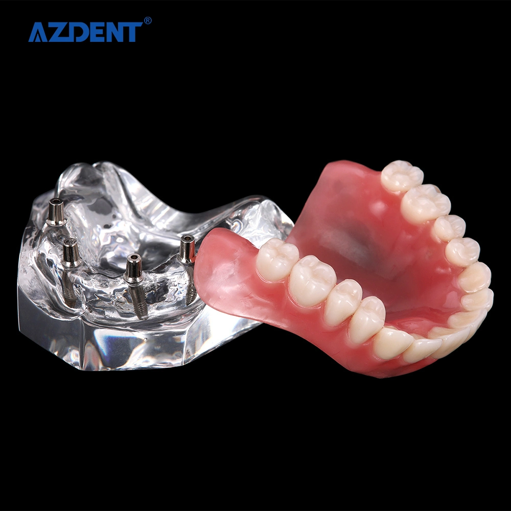 High quality/High cost performance CE Certified Standard Plastic Dental Implant Teeth Model