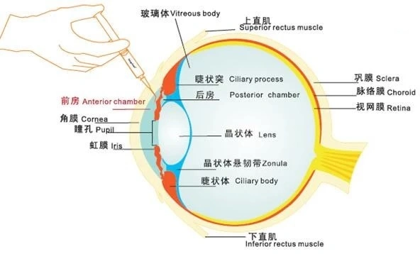 Hyaluronic Acid with Logo Printing Viscoelastic in Anterior Segment Surgery Solution