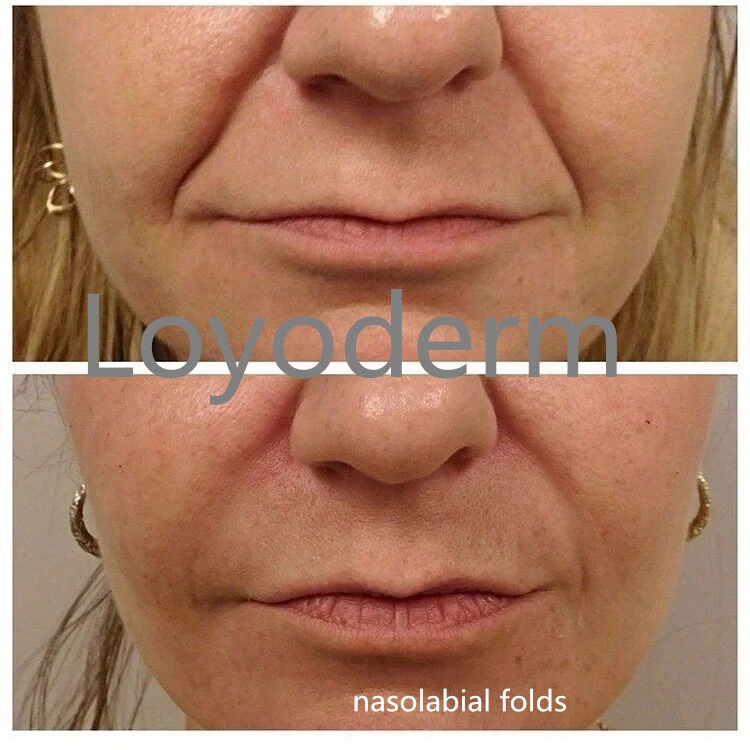 Bdde Cross Linked Ha Relleno De Acido Hialuronico Dermal Filler Cost